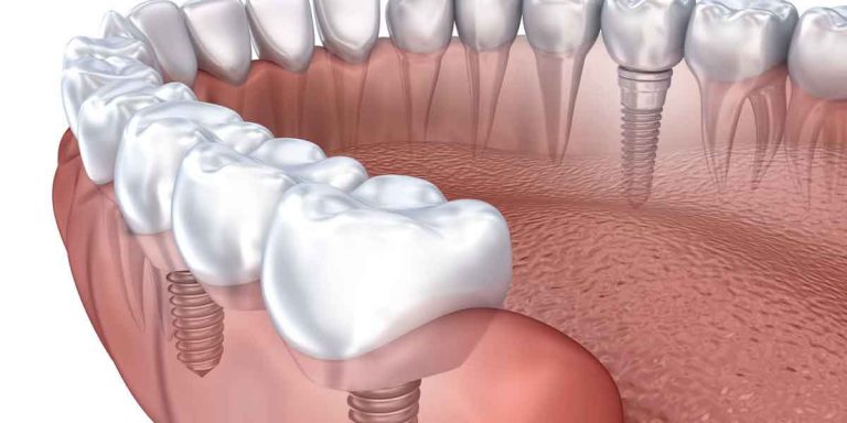 Learn How Dental Implants Could Help Your Dental Health